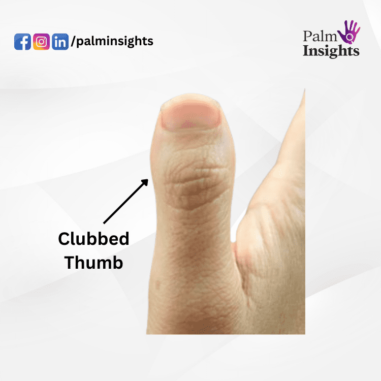 Clubbed-Thumb-In-Palmistry