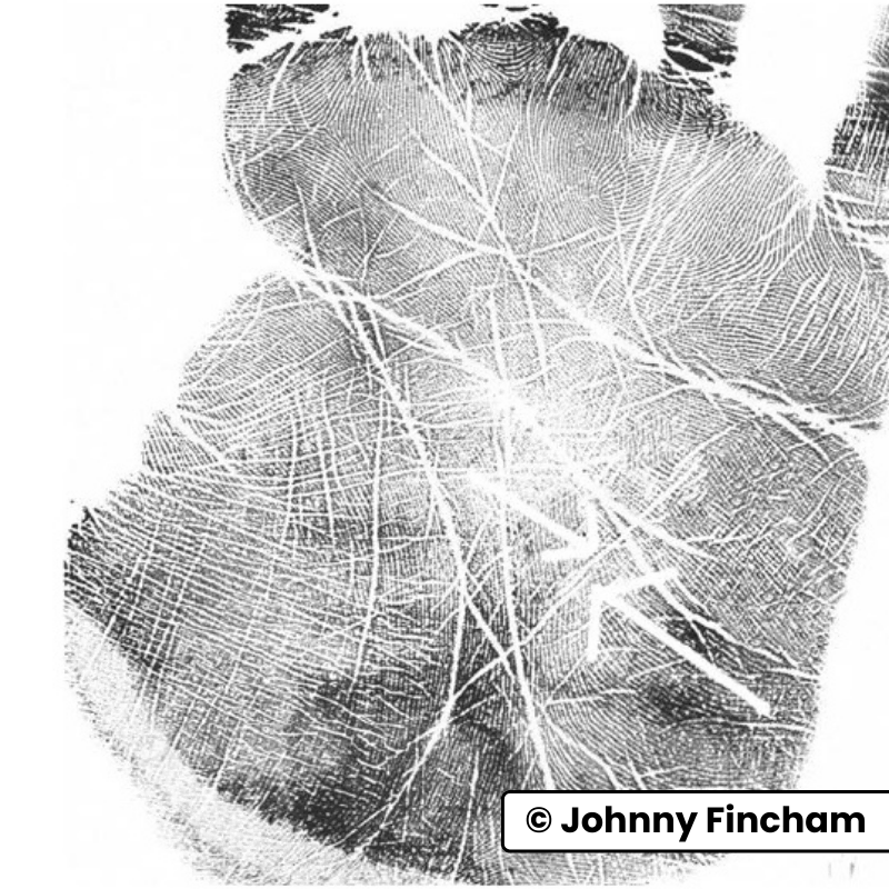 Black‑and‑white palm print with discontinuous health line, depicting the meaning of a broken health line in palmistry.